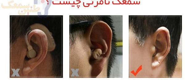 عکس کاشت حلزون نامرئی