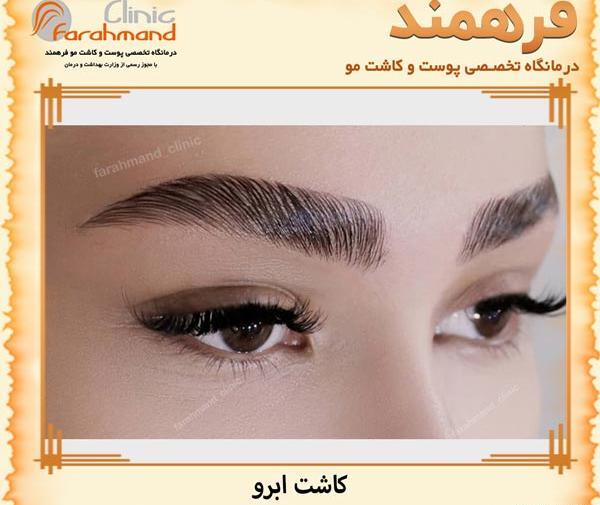عکس کاشت ابرو قبل و بعد