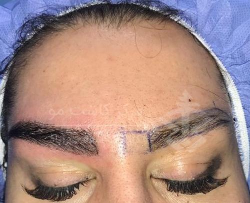 عکس کاشت ابرو قبل و بعد