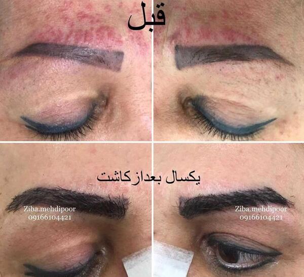 عکس کاشت ابرو قبل و بعد