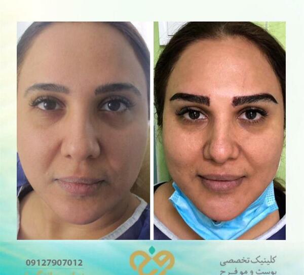 عکس کاشت ابرو قبل و بعد