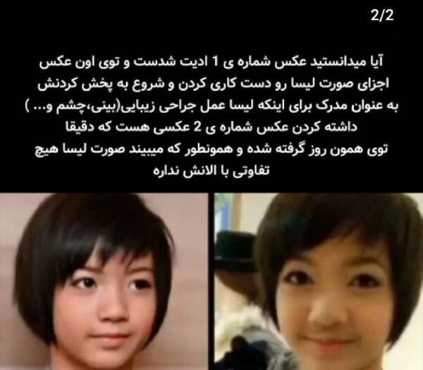 عکس رزی قبل عمل
