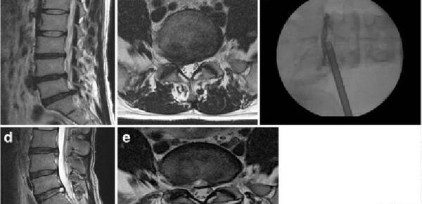 عکس ام ار ای پارگی دیسک کمر
