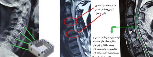 عکس ام ار ای پارگی دیسک کمر