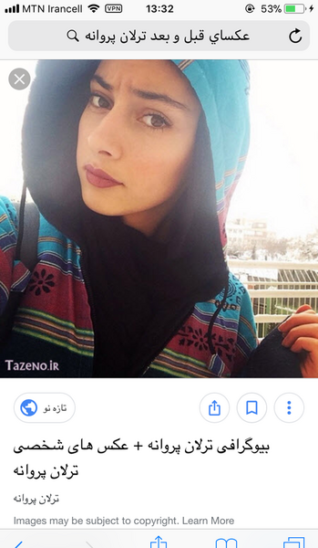 عکس های ترلان پروانه قبل از عمل زیبایی