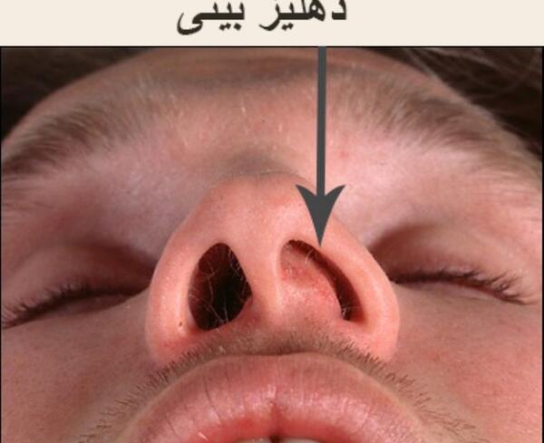 عکس داخل بینی انسان