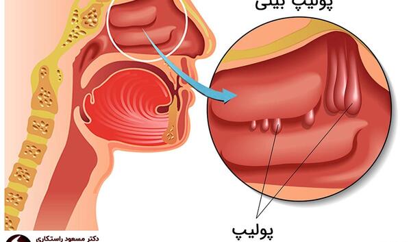 عکس داخل بینی انسان