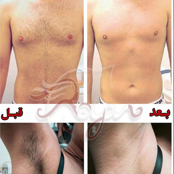عکس تصاویر لیزر موهای بدن