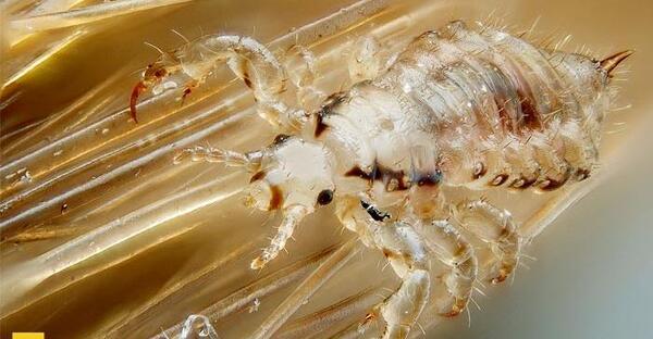 عکس شپش و رشک سر