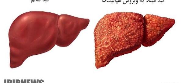 عکس ویروس هپاتیت بی