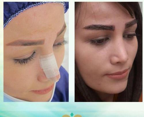 عکس کاشت ابرو طبیعی