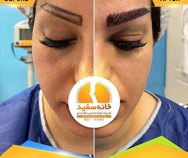 عکس کاشت ابرو طبیعی