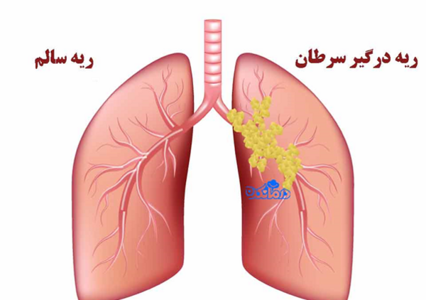 عکس ریه ی انسان