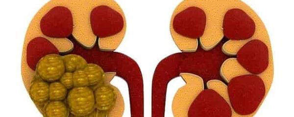 عکس سنگ ریزه کلیه