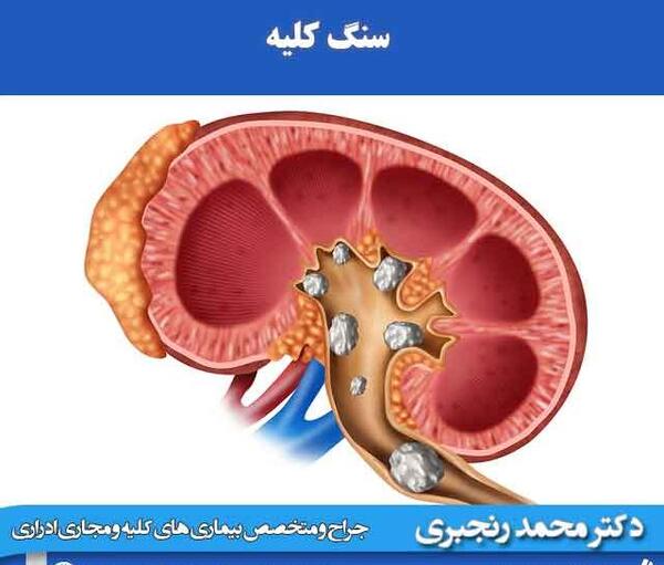 عکس سنگ ریزه کلیه