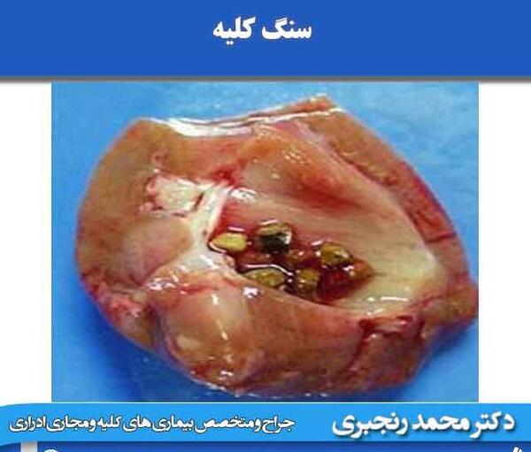 عکس سنگ ریزه کلیه