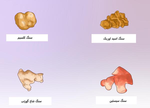 عکس سنگ ریزه کلیه