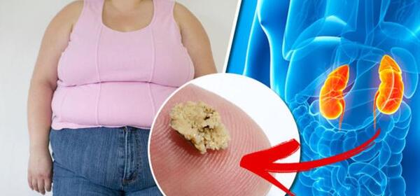 عکس سنگ کلیه 4 میلیمتری
