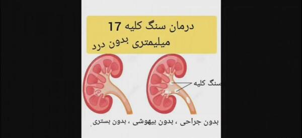 عکس سنگ کلیه 4 میلیمتری