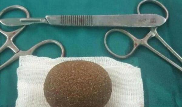 عکس سنگ کلیه 4 میلیمتری