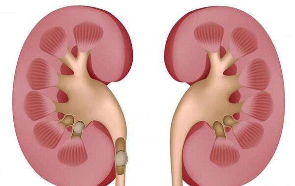 عکس سنگ کلیه 4 میلیمتری