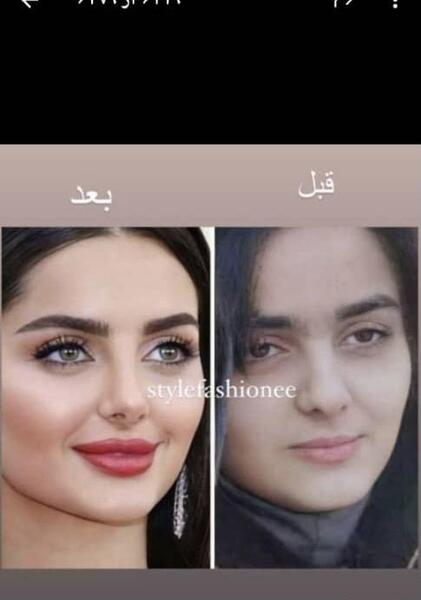 عکس قبل عمل مه لقا جابری