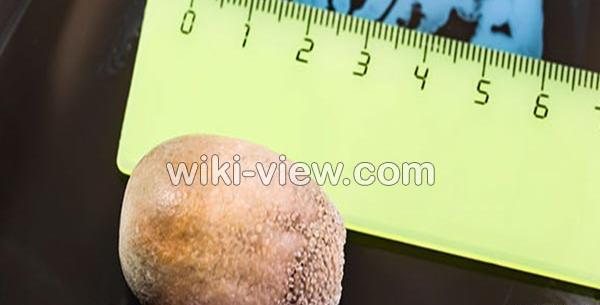 عکس سنگ صفرا دفع شده