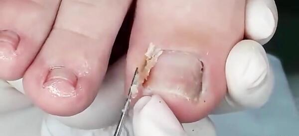 عکس ناخن چرک کرده