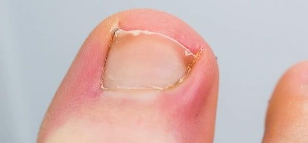 عکس ناخن چرک کرده