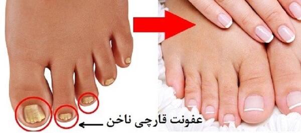 عکس ناخن چرک کرده