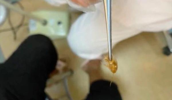 عکس سوسک در گوش