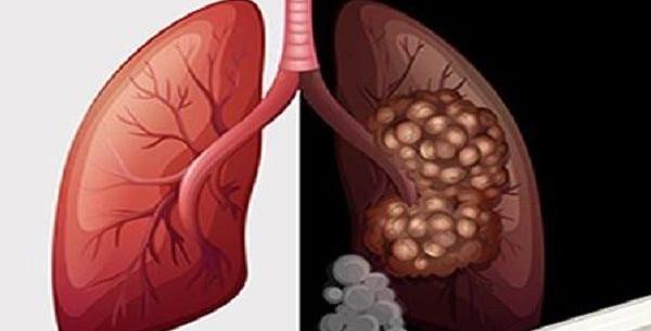 عکس ریه تهرانپارس