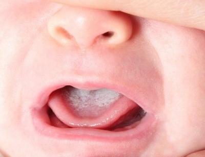 عکس سفید شدن زبان نوزاد