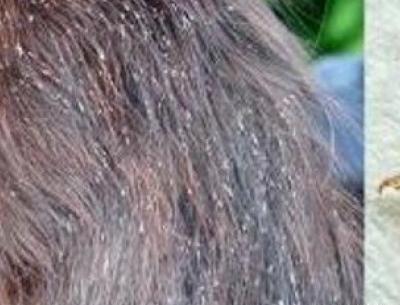 عکس شپش نابالغ