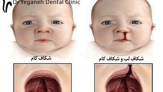 عکس لب شکری