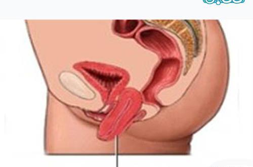 عکس ام ار ای رحم
