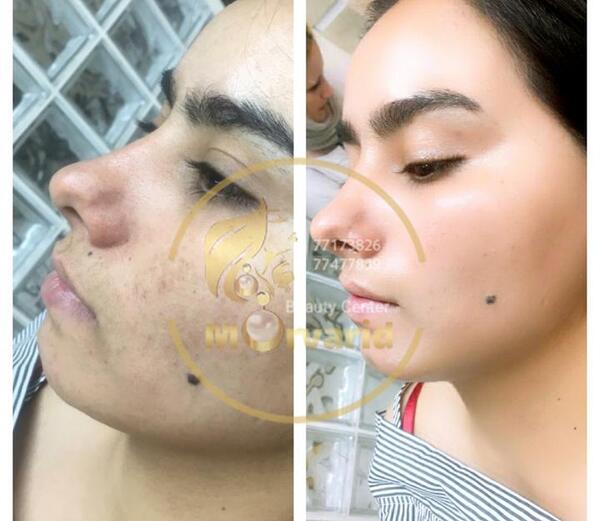 عکس قبل و بعد کرم پودر دائم