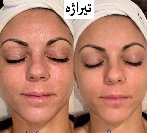 عکس قبل و بعد کرم پودر دائم