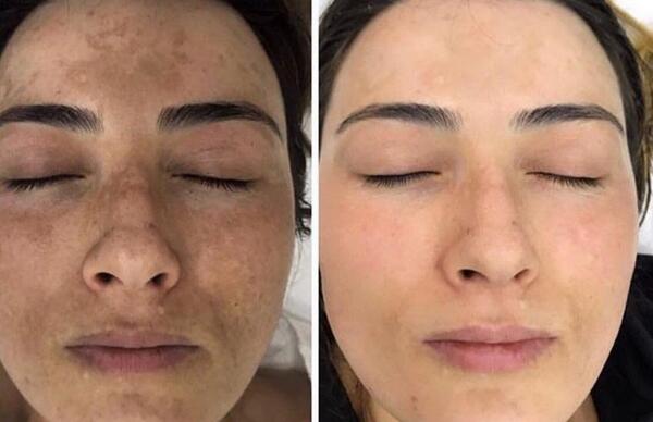عکس قبل و بعد کرم پودر دائم