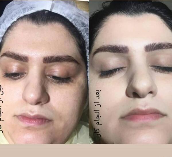 عکس قبل و بعد کرم پودر دائم