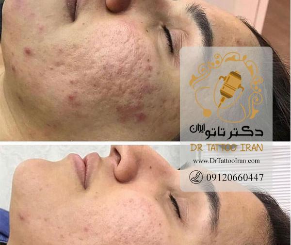 عکس قبل و بعد کرم پودر دائم
