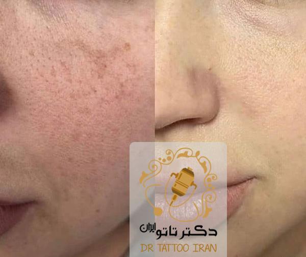 عکس قبل و بعد کرم پودر دائم