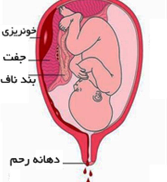 لانه عکس لکه بینی در اوایل بارداری