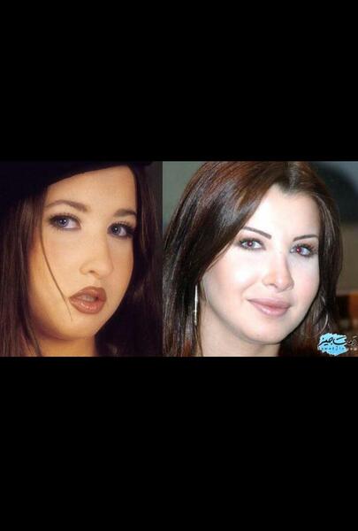 عکس نانسی قبل عمل