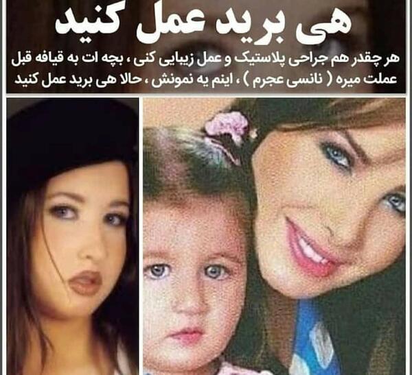 عکس نانسی قبل عمل