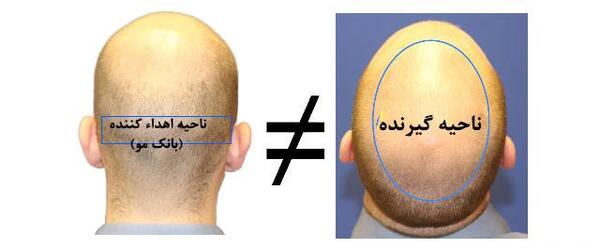 عکس کاشت مو وسط سر