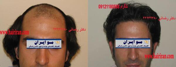 عکس کاشت مو وسط سر