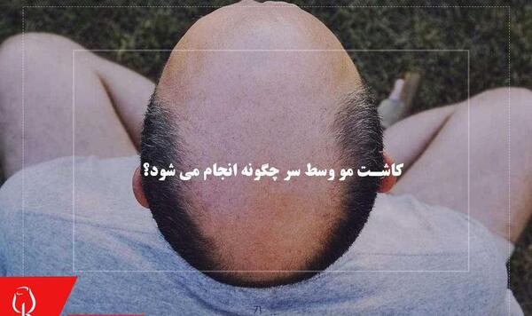 عکس کاشت مو وسط سر