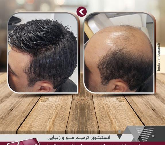 عکس کاشت مو وسط سر