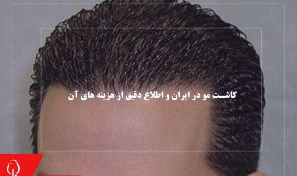 عکس کاشت مو وسط سر